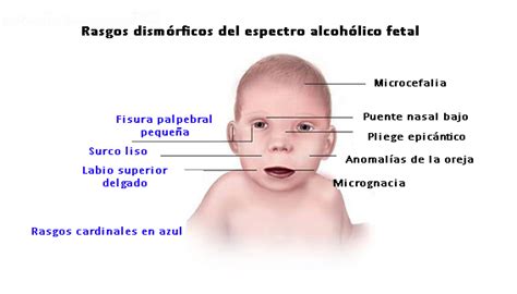 Ilustración de los rasgos faciales característicos del Síndrome Alcohólico Fetal.