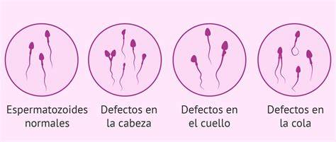 Infografía de los diferentes tipos de alteraciones espermáticas