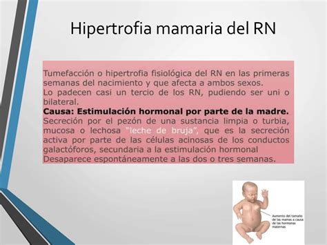 Infografía o esquema sobre la hipertrofia mamaria neonatal en bebés