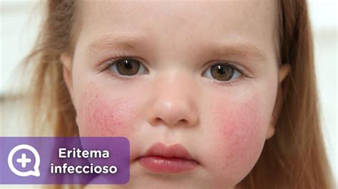 Eritema infeccioso con el típico patrón de