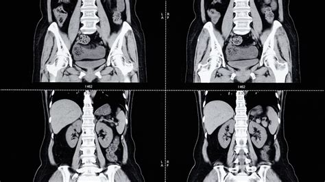 Imagen de resonancia magnética abdominal mostrando lesiones quísticas multiloculadas.