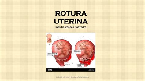 Representación esquemática de la pared uterina mostrando una ruptura completa e incompleta.