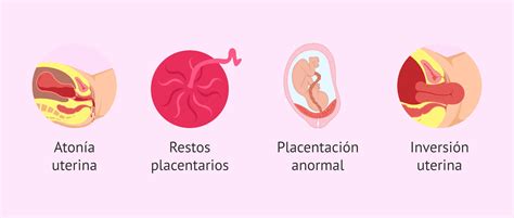 Diagrama que ilustra las diferentes causas de hemorragia posparto: atonía uterina, laceraciones y retención de placenta.