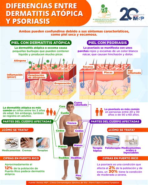 Infografía comparativa: diferencias visuales entre dermatitis irritativa (zonas convexas) y candidiasis (se concentra en pliegues).